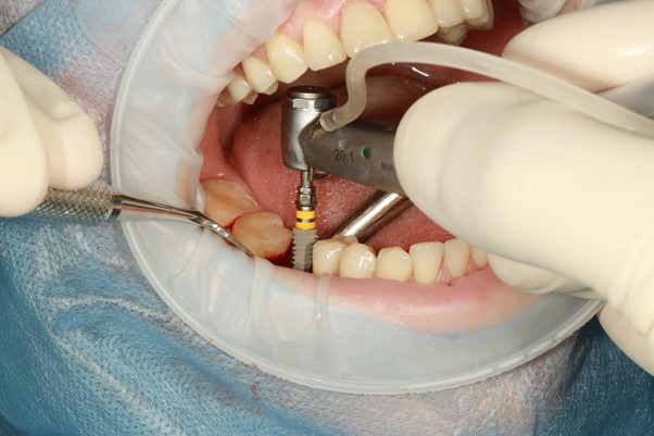 The Ultimate Guide to Dental Implants